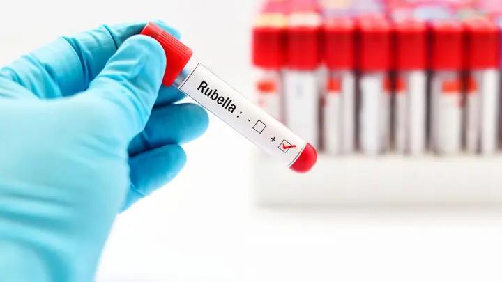 Biểu Hiện Của Bệnh Rubella Ở Bà Bầu