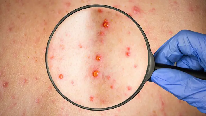 Biểu Hiện Của Bệnh Rubella Ở Bà Bầu