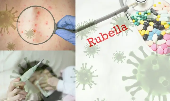 Biểu Hiện Của Bệnh Rubella Ở Bà Bầu