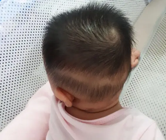 Biểu Hiện Trẻ Em Thiếu Canxi