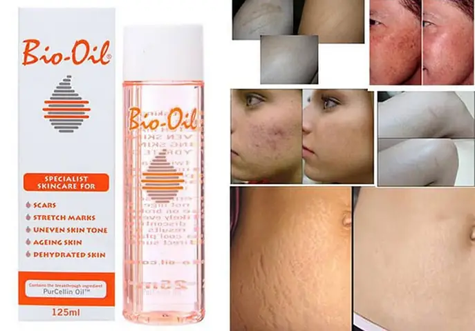 Bio Oil Trị Rạn Da Có Tốt Không