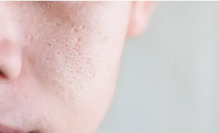 Bộ Trị Mụn Tốt Nhất Hiện Nay