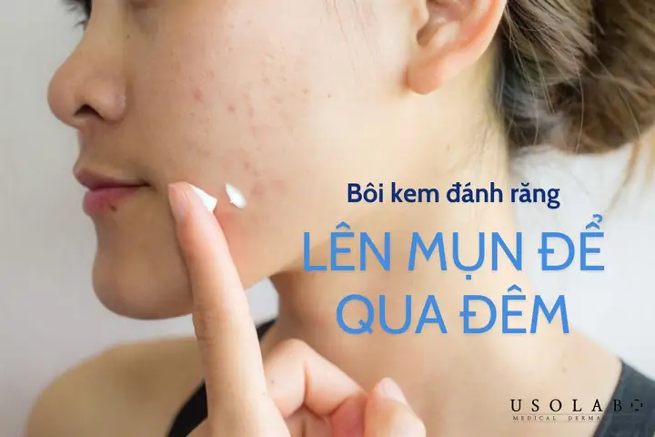Bôi Kem Trị Mụn Qua Đêm