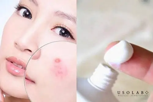 Bôi Kem Trị Mụn Qua Đêm