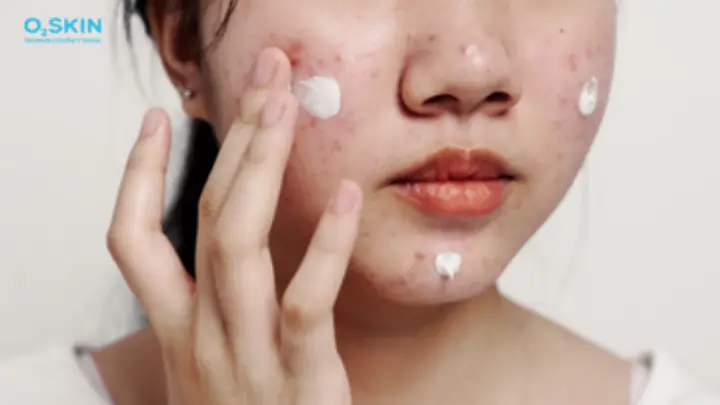 Bôi Kem Trị Mụn Trước Hay Sau Kem Chống Nắng