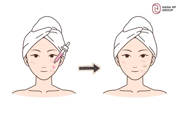 Bôi Kem Trị Mụn Trước Hay Sau Serum