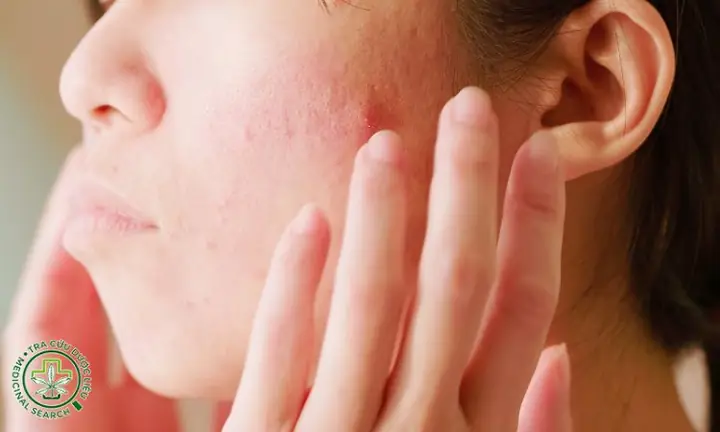 Bôi Sữa Ong Chúa Bị Ngứa Bôi Sữa Ong Chúa Bị Ngứa