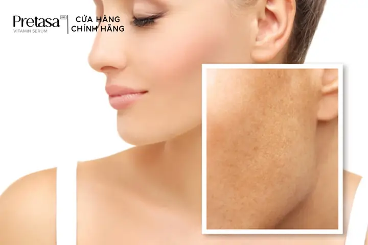 Bôi Vitamin C Bị Sạm Da