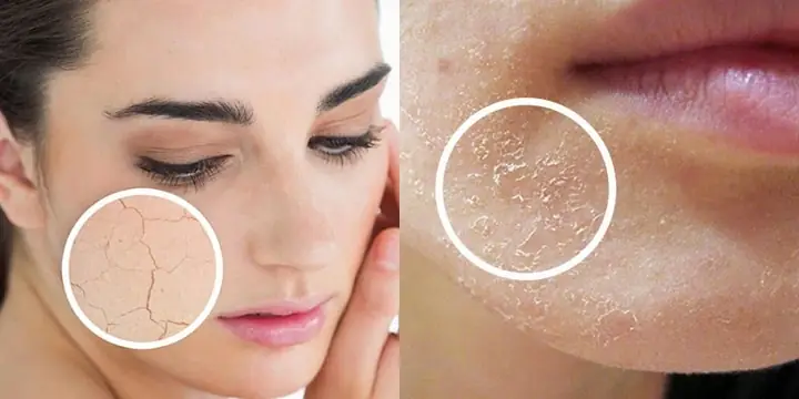 Bong Tróc Da Mặt Là Bệnh Gì