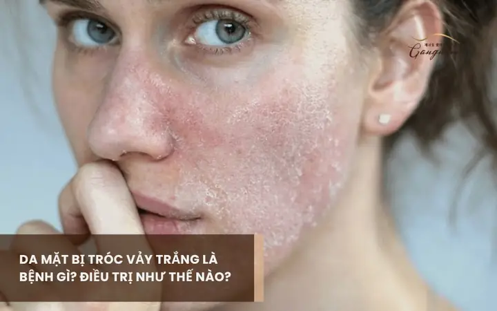 Bong Tróc Da Mặt Là Bệnh Gì