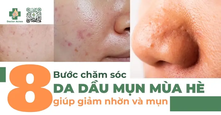 Các Bước Chăm Sóc Da Dầu Mụn Mùa Hè