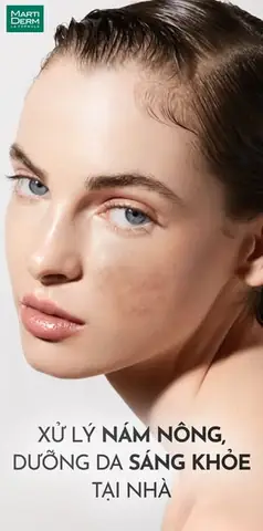 Các Bước Dưỡng Da Trị Nám