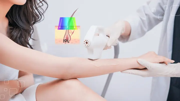 Các Công Nghệ Triệt Lông Vĩnh Viễn