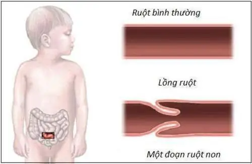 Các Loại Đau Bụng Ở Trẻ