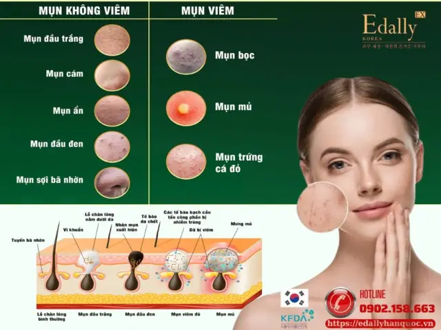 Các Loại Mỹ Phẩm Trị Mụn Hiệu Quả