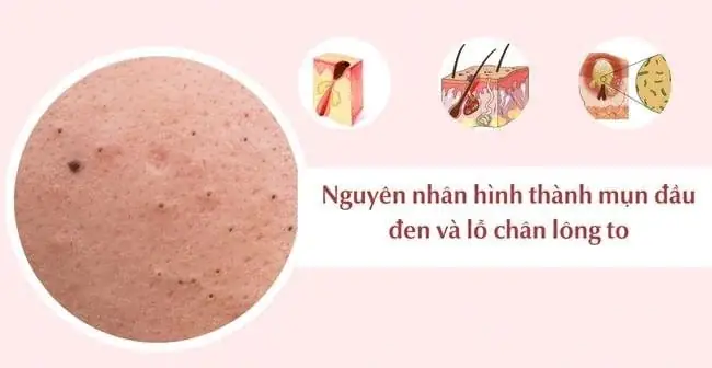 Các Sản Phẩm Trị Mụn Đầu Đen