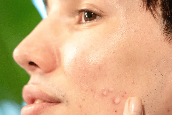 Các Thành Phần Tốt Cho Da Mụn