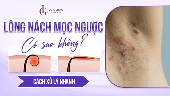 Cách Cạo Lông Nách Không Mọc Lại