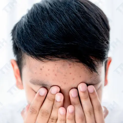 Cách Chăm Sóc Da Cho Tuổi Dậy Thì