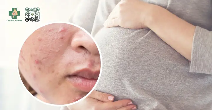 Cách Chăm Sóc Da Mụn Cho Bà Bầu