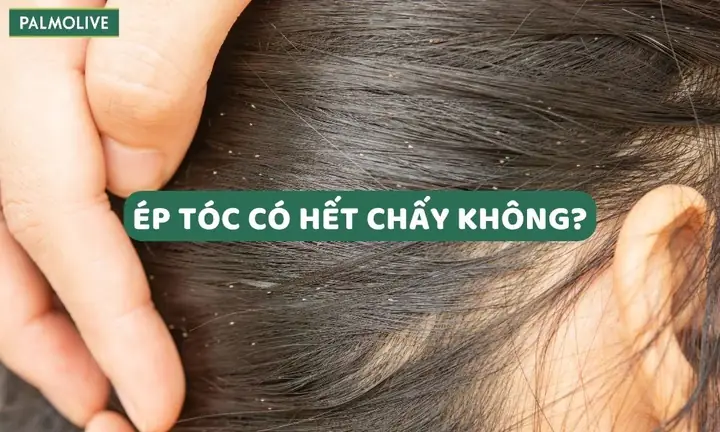 Cách Chữa Chấy Hiệu Quả Nhất Cách Chữa Chấy Hiệu Quả Nhất