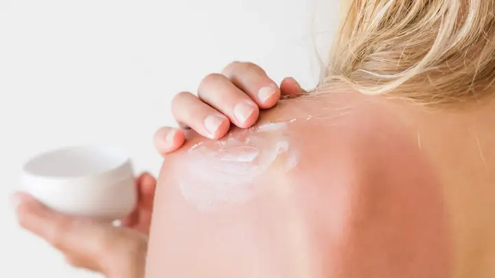 Cách Chữa Cháy Nắng Bằng Sữa Chua