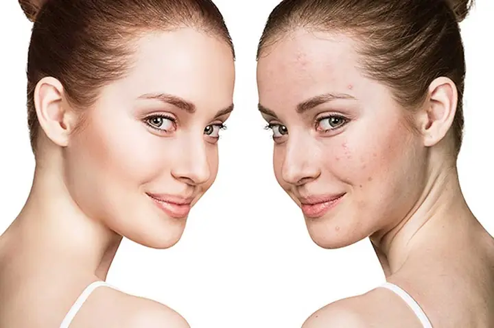 Cách Chữa Dị Ứng Da Mặt Bằng Mướp Đắng