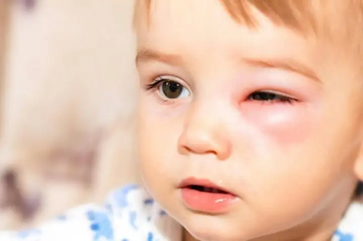 Cách Chữa Lẹo Mắt Cho Trẻ Em