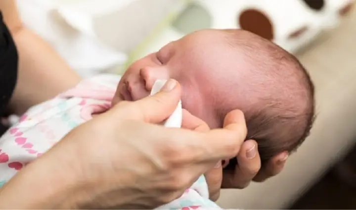 Cách Chữa Lẹo Mắt Cho Trẻ Em