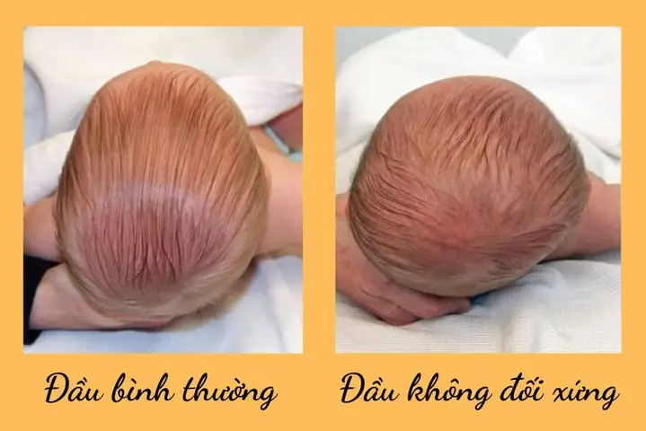 Cách Chữa Méo Đầu Ở Trẻ Sơ Sinh
