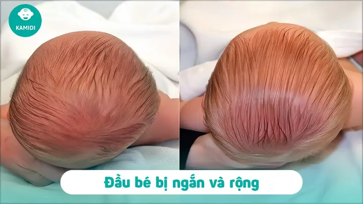 Cách Chữa Méo Đầu Ở Trẻ Sơ Sinh
