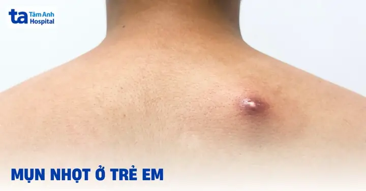 Cách Chữa Mụn Nhọt Cho Bé