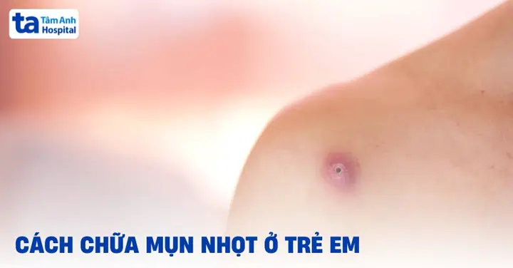 Cách Chữa Mụn Nhọt Cho Bé