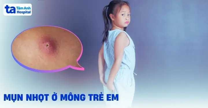 Cách Chữa Mụn Nhọt Cho Bé