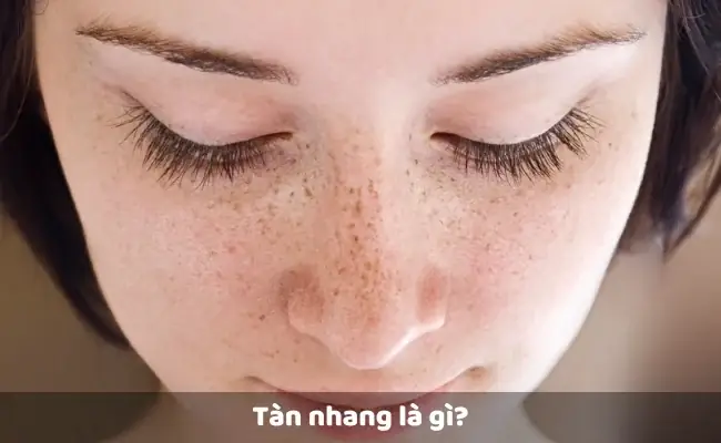 Cách Chữa Tàn Nhang Tại Nhà Hiệu Quả Nhất
