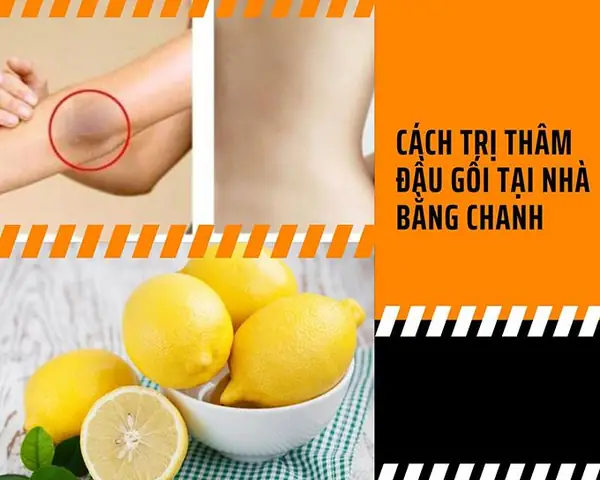 Cách Chữa Thâm Đầu Gối Tại Nhà