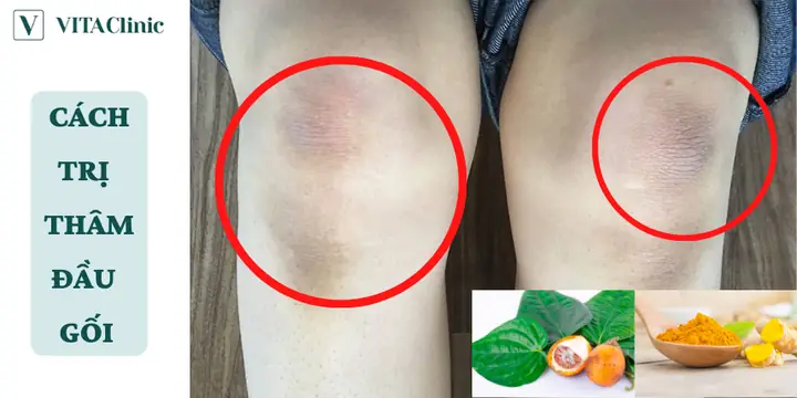 Cách Chữa Thâm Đầu Gối Tại Nhà Cách Chữa Thâm Đầu Gối Tại Nhà