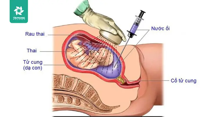 Cách Chữa Thiếu Nước Ối Ở Bà Bầu