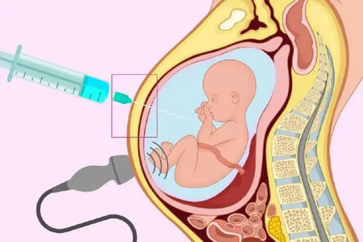 Cách Chữa Thiếu Nước Ối Ở Bà Bầu