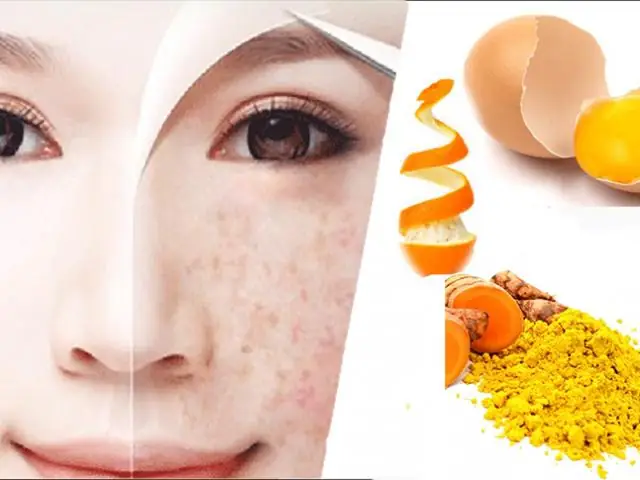 Cách Chữa Trị Tàn Nhang Tại Nhà