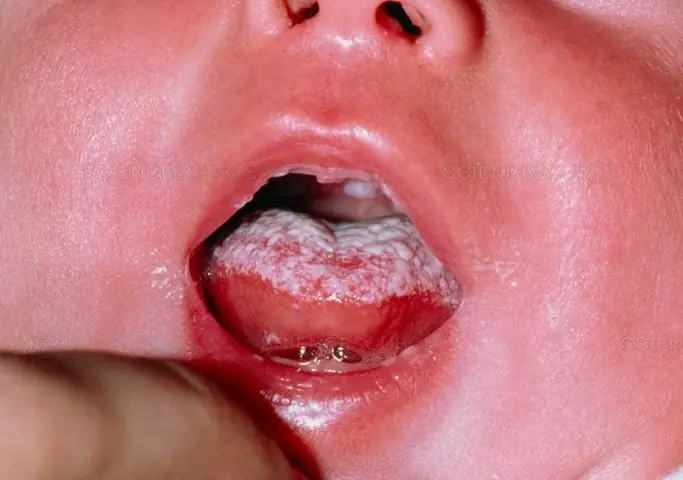 Cách Đánh Sạch Tưa Lưỡi Cho Trẻ Sơ Sinh Cách Đánh Sạch Tưa Lưỡi Cho Trẻ Sơ Sinh