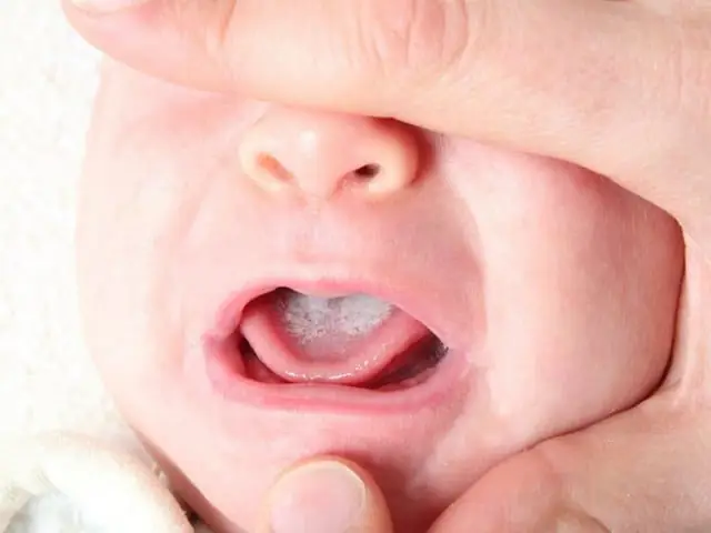 Cách Đánh Sạch Tưa Lưỡi Cho Trẻ Sơ Sinh Cách Đánh Sạch Tưa Lưỡi Cho Trẻ Sơ Sinh