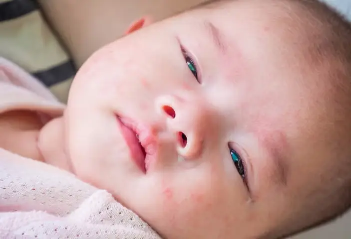 Cách Điều Trị Đau Mắt Đỏ Ở Trẻ Sơ Sinh