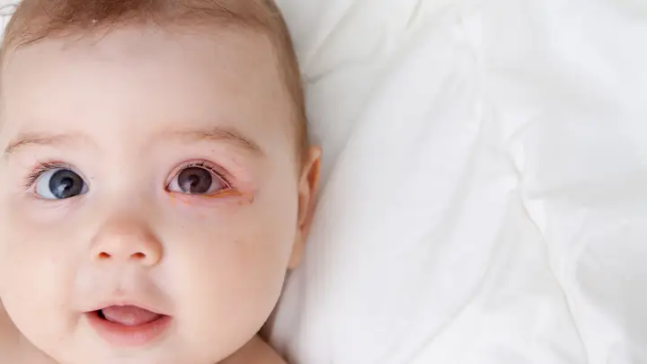 Cách Điều Trị Đau Mắt Đỏ Ở Trẻ Sơ Sinh