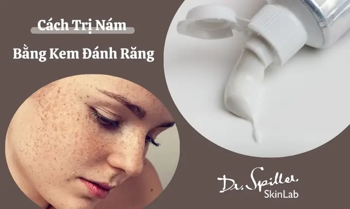Cách Điều Trị Nám Bằng Kem Đánh Răng Cách Điều Trị Nám Bằng Kem Đánh Răng
