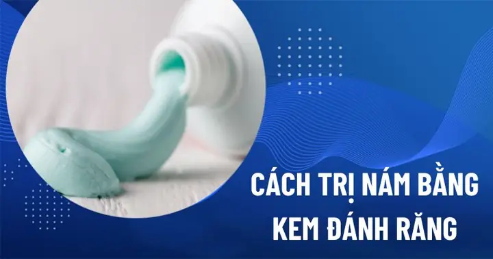 Cách Điều Trị Nám Bằng Kem Đánh Răng Cách Điều Trị Nám Bằng Kem Đánh Răng