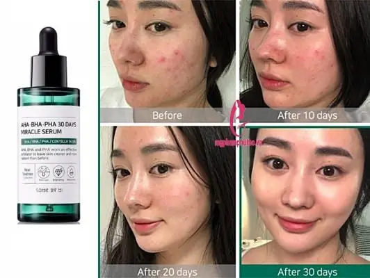 Cách Dùng Serum Trị Mụn Some By Mi