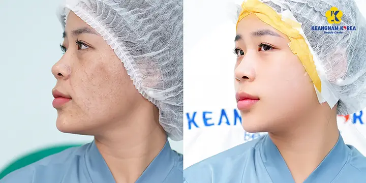Cách Dưỡng Ẩm Da Khô Tại Nhà