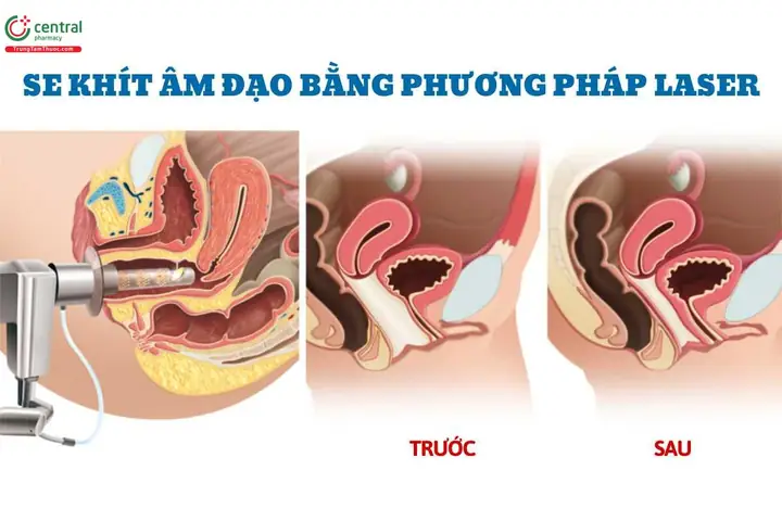 Cách Làm Cho Cô Bé Hồng Hào Se Khít Cách Làm Cho Cô Bé Hồng Hào Se Khít