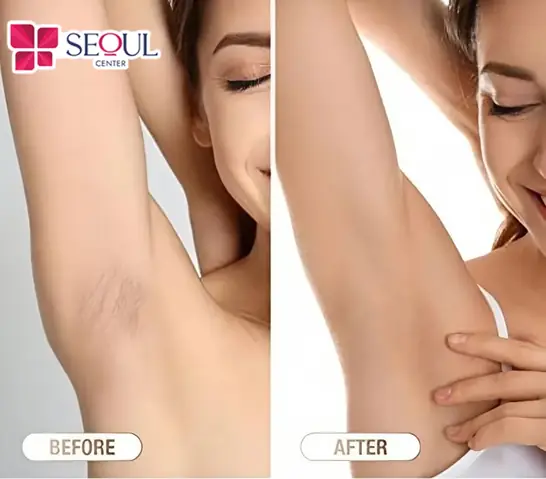 Cách Làm Hết Lông Nách Vĩnh Viễn Tại Nhà
